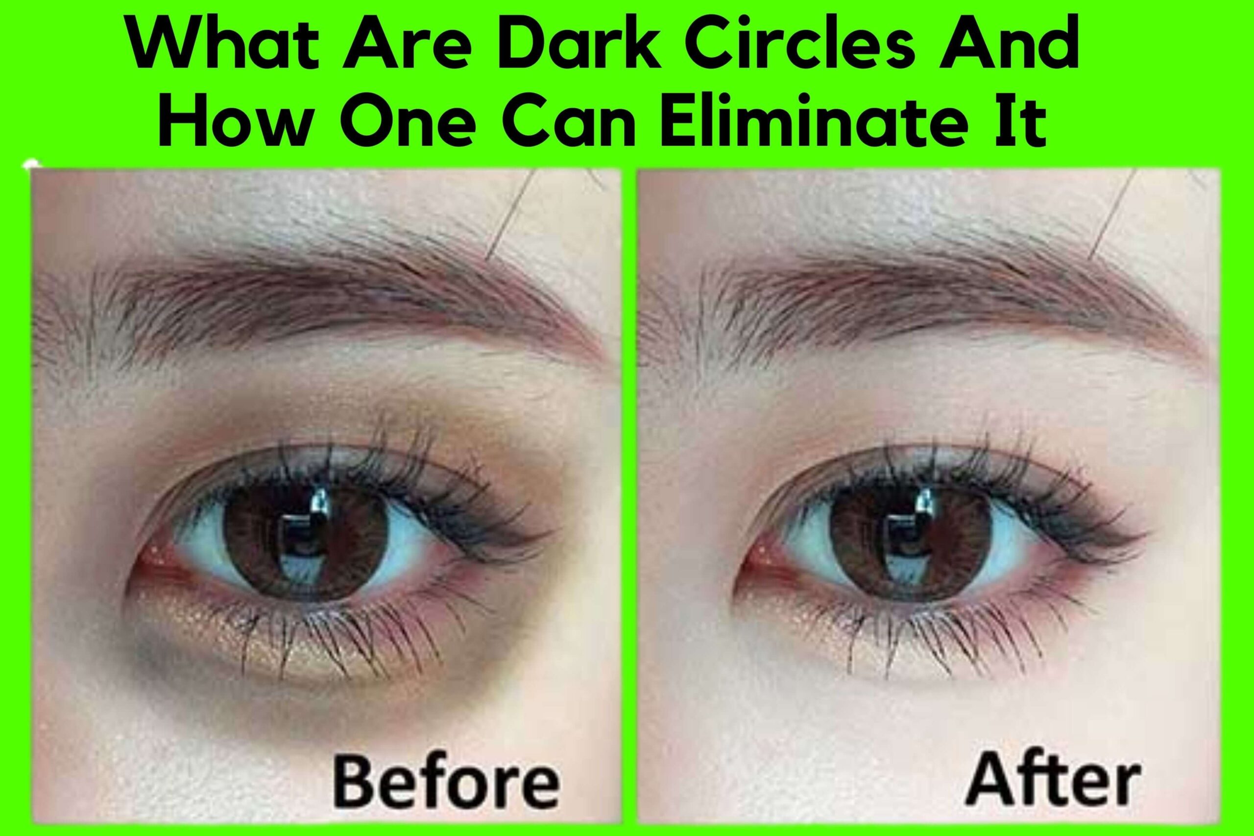 dark circles